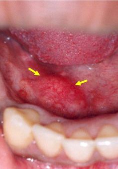 Những căn bệnh ung thư lạ lùng ít người biết