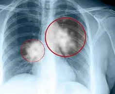 Xét nghiệm DNA giúp chống lại bệnh lao ở Madagascar