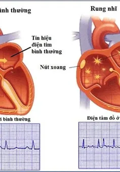 Nhận biết sớm rung nhĩ, dự phòng đột quỵ và các biến chứng liên quan
