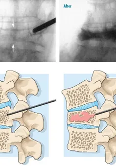 Phẫu thuật cột sống không phải là phương pháp hữu hiệu để giảm đau lưng do loãng xương