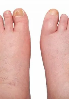 Phù chân – dấu hiệu của nhiều bệnh lý nguy hiểm
