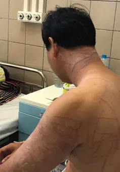 Du khách nhập viện vì bị sứa đốt