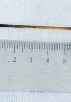Ngủ quên, người đàn ông nuốt luôn cây tăm dài 7cm