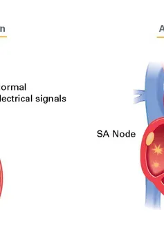 Phát hiện dấu ấn sinh học mới trong điều trị bệnh tim