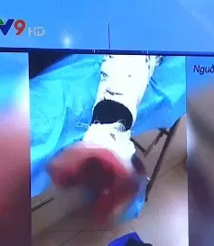 Vừa sạc vừa dùng điện thoại, thiếu niên 17 tuổi bị nát bàn tay