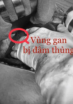 Báo động đỏ cứu nam thanh niên bị thủng tim, gan nguy kịch