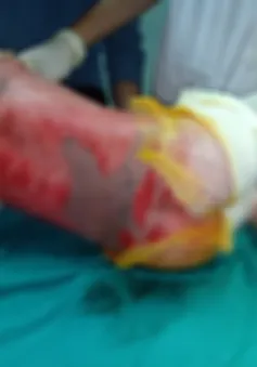 Tuyên Quang: Liên tiếp trẻ nhập viện do bỏng nước sôi