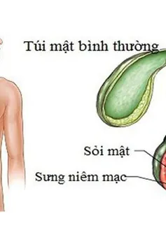 Những biến chứng nguy hiểm của sỏi mật