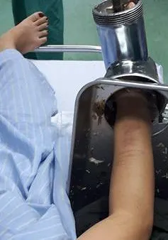 Xay thịt nấu bữa trưa, người phụ nữ bị cuốn cả bàn tay vào máy xay thịt