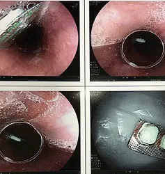 Người đàn ông phải đi viện vì uống thuốc còn nguyên vỏ