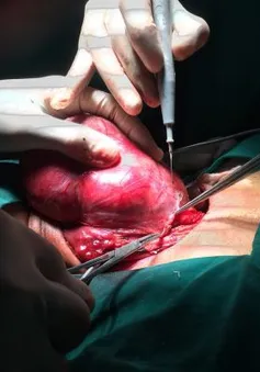 Khối u giáp khổng lồ chèn ép khí quản người phụ nữ