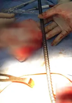Nam công nhân nhập viện với thanh sắt dài 65cm đâm xuyên ngực