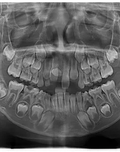 Cảnh giác rối loạn mọc răng vĩnh viễn ở trẻ em