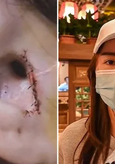 Người phụ nữ Trung Quốc bị mất một phần tai sau khi phẫu thuật mũi