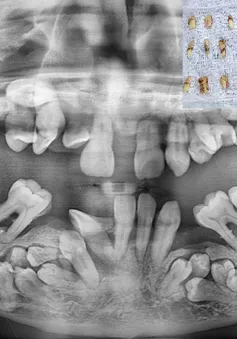 Răng mọc ngầm chi chít trong khoang miệng người đàn ông