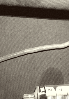 Nội soi gắp giun đũa dài 25cm trong ống mật chủ
