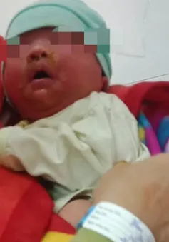 Cảnh báo trẻ sơ sinh bị dị ứng nặng do được tắm bằng lá cây