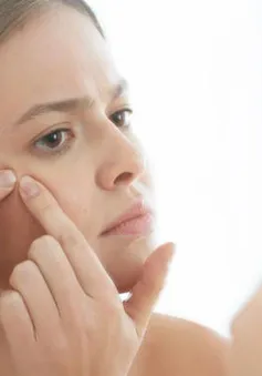 Mẹo nặn mụn hiệu quả mà không để lại thâm sẹo