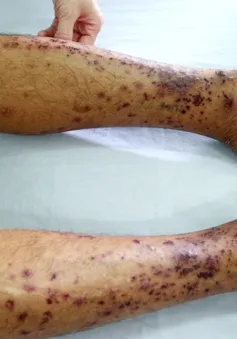 Điều trị thành công cho bệnh nhân bị ban xuất huyết Schonlein-Henoch