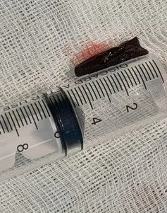 Lấy mảnh gỗ dài 3cm nằm trong cổ bệnh nhân suốt... 4 tháng