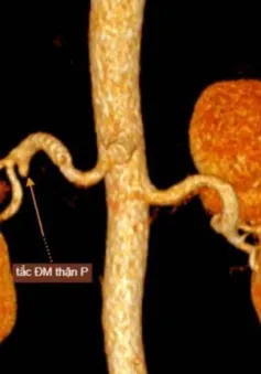 Đi khám vì đau bụng, người đàn ông phát hiện mắc bệnh lý thận hiếm gặp