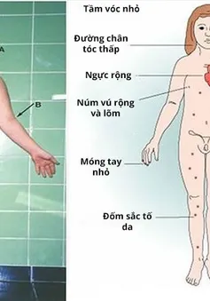 Thấy con thấp hơn bạn cùng trang lứa, đưa đi khám phát hiện mắc hội chứng Turner