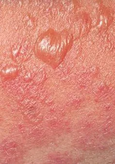 Cảnh báo: Dùng thuốc không rõ nguồn gốc, bệnh nhân mắc hội chứng hiếm gặp