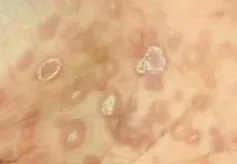 Quan hệ tình dục không an toàn, người đàn ông đồng nhiễm giang mai, HIV