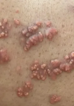 U nổi khắp người do rối loạn mỡ máu