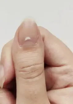 Phát hiện chấm trắng trên móng tay có thể bắt nguồn từ 6 nguyên nhân này