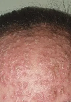 Eczema và nhiều nguy cơ tiềm ẩn