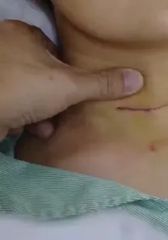 Biến chứng do lạm dụng tiêm cồn chữa u tuyến giáp