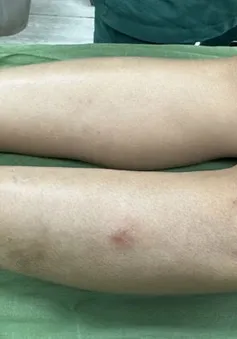 Cấy chỉ trị giảm đau, người phụ nữ phải nhập viện do nhiễm trùng