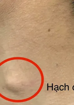 Phát hiện mắc ung thư thực quản sau thời gian bị nuốt nghẹn, gầy sút cân
