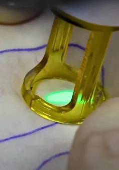 Những bước tiến mới trong việc điều trị suy giãn tĩnh mạch hiện nay