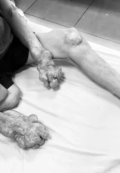 Cảnh báo biến chứng nhiễm trùng hạt tophi do bệnh gout lâu năm