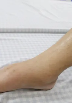 Phù nề toàn thân do uống thuốc nam không rõ nguồn gốc