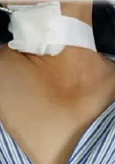 Tự tiêm thuốc ở nhà và những hệ lụy