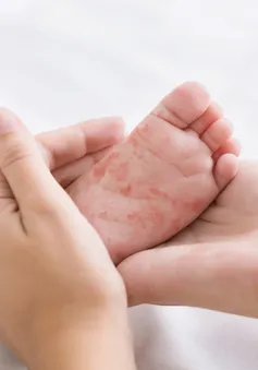 Ghi nhận hơn 10.000 ca mắc rubella, Nam Phi ra cảnh báo y tế toàn quốc