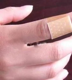 Cách chăm sóc những vết thương nhỏ đúng cách