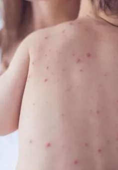 Đề phòng bệnh da liễu khi thời tiết nồm ẩm kéo dài
