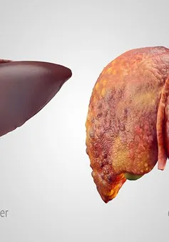 Loại thực phẩm giúp ngăn ngừa và đảo ngược tình trạng gan nhiễm mỡ