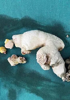 Loại bỏ sỏi thận san hô cho người phụ nữ
