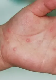 Hà Nội phát sinh 5 ổ dịch tay chân miệng trong tuần qua
