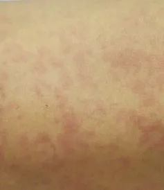 Cứu sống bé trai 8 tháng tuổi bị sởi biến chứng suy hô hấp nặng
