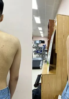Khám miễn phí gù, vẹo cột sống cho trẻ dưới 18 tuổi