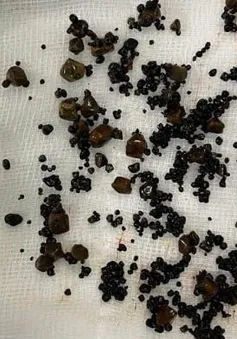 Lấy hàng trăm viên sỏi trong túi mật hai ngăn hiếm gặp