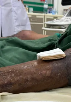 Nguy kịch vì viêm mô bào sau khi bị gai đâm vào chân ở đầm tôm