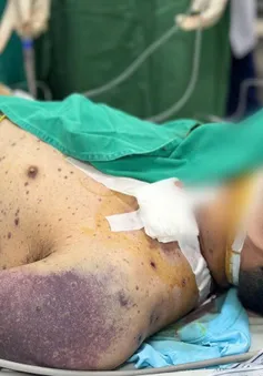 Biến chứng thủy đậu nguy kịch: Một ca xin về, một ca vẫn thở máy