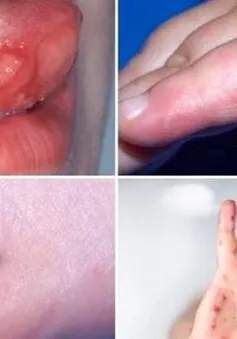 TP Hồ Chí Minh: Số ca mắc bệnh tay chân miệng tiếp tục tăng
